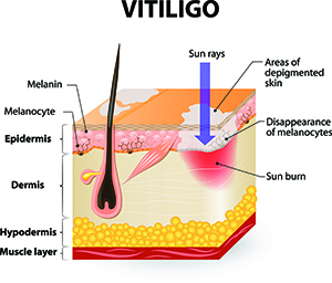 UV lamps for vitiligo