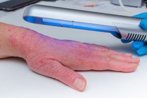 UV lamp for eczema