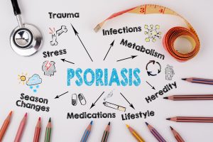 UV Light for Psoriasis