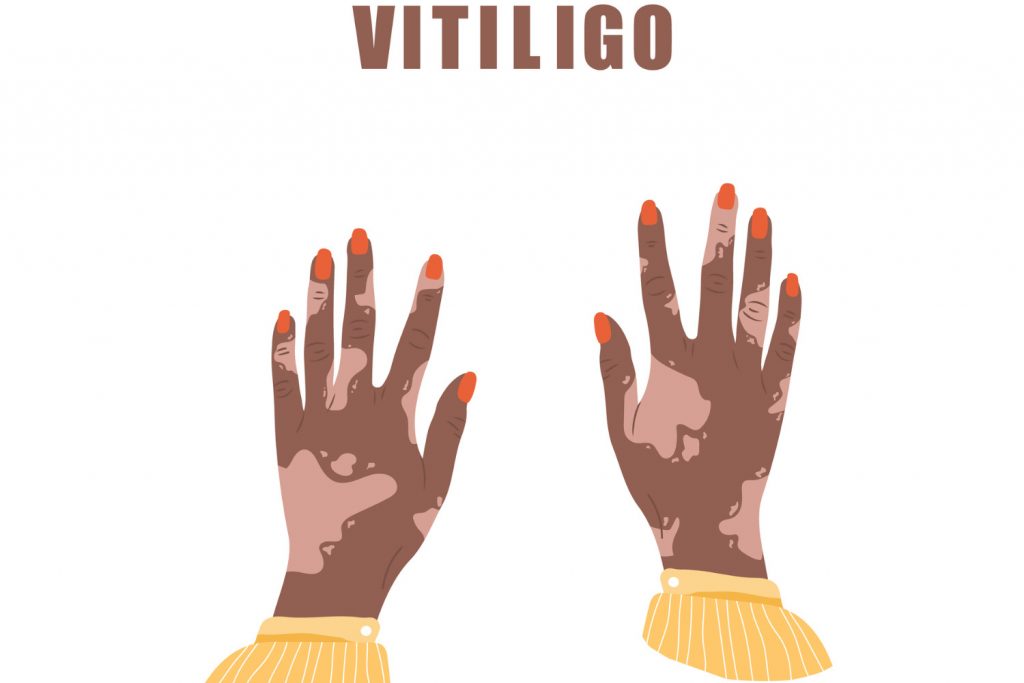UV Light for Vitiligo